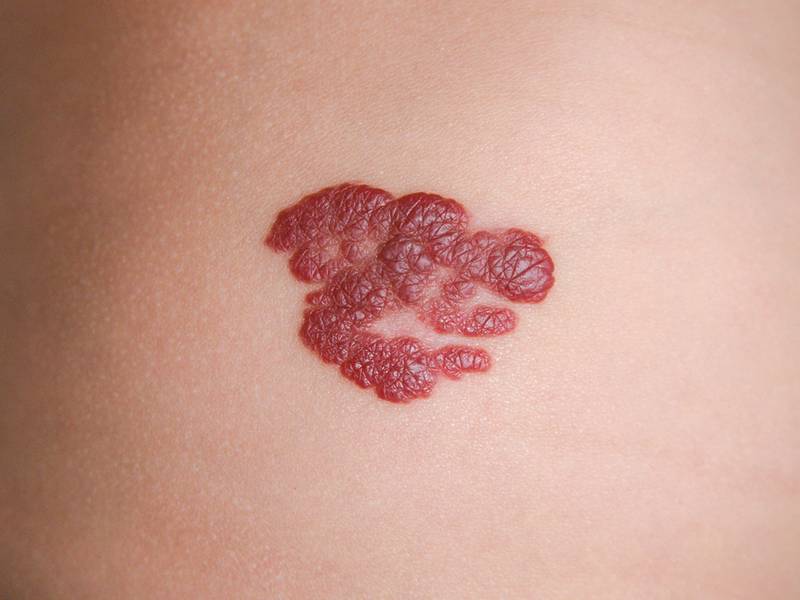 Aardbeienvlek of hemangioom bij baby