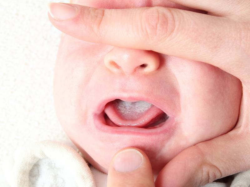 Huilende baby met spruw op tong